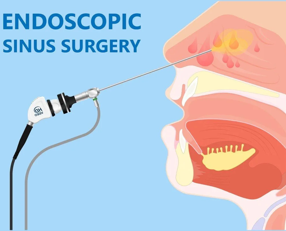 Endoscopic Sinus Surgery