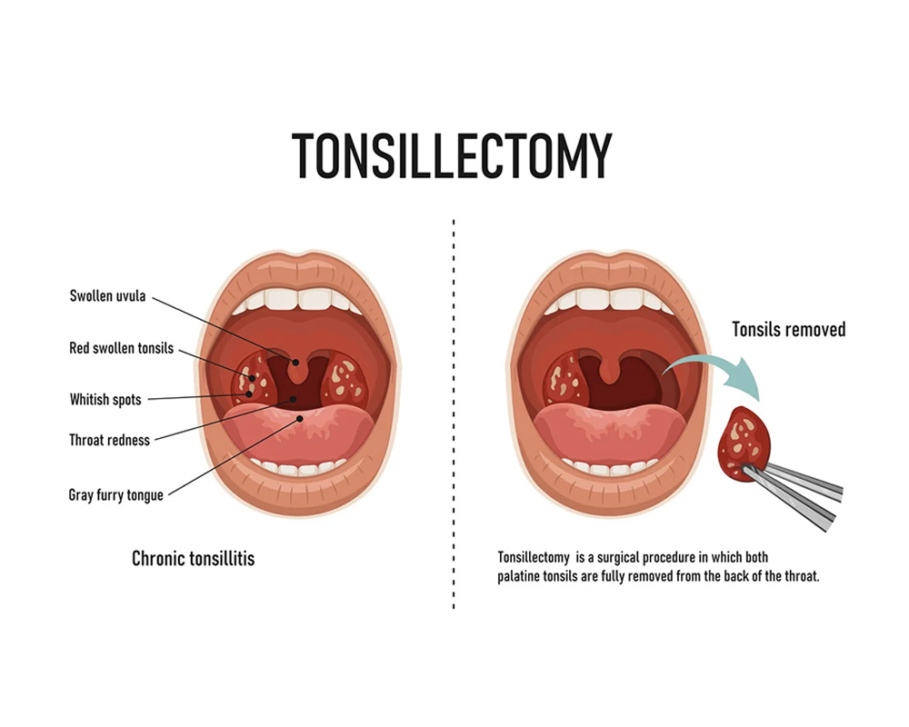 Tonsillectomy Surgery
